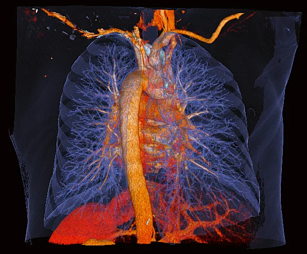 3D volume rendering of the chest showing airways, lungs and vessels