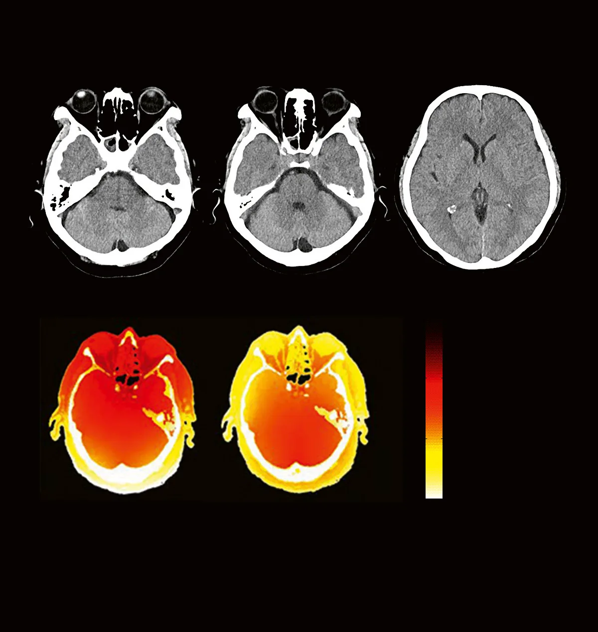 Brain CT slices above absorbed-dose maps comparing scans with and without X-CARE