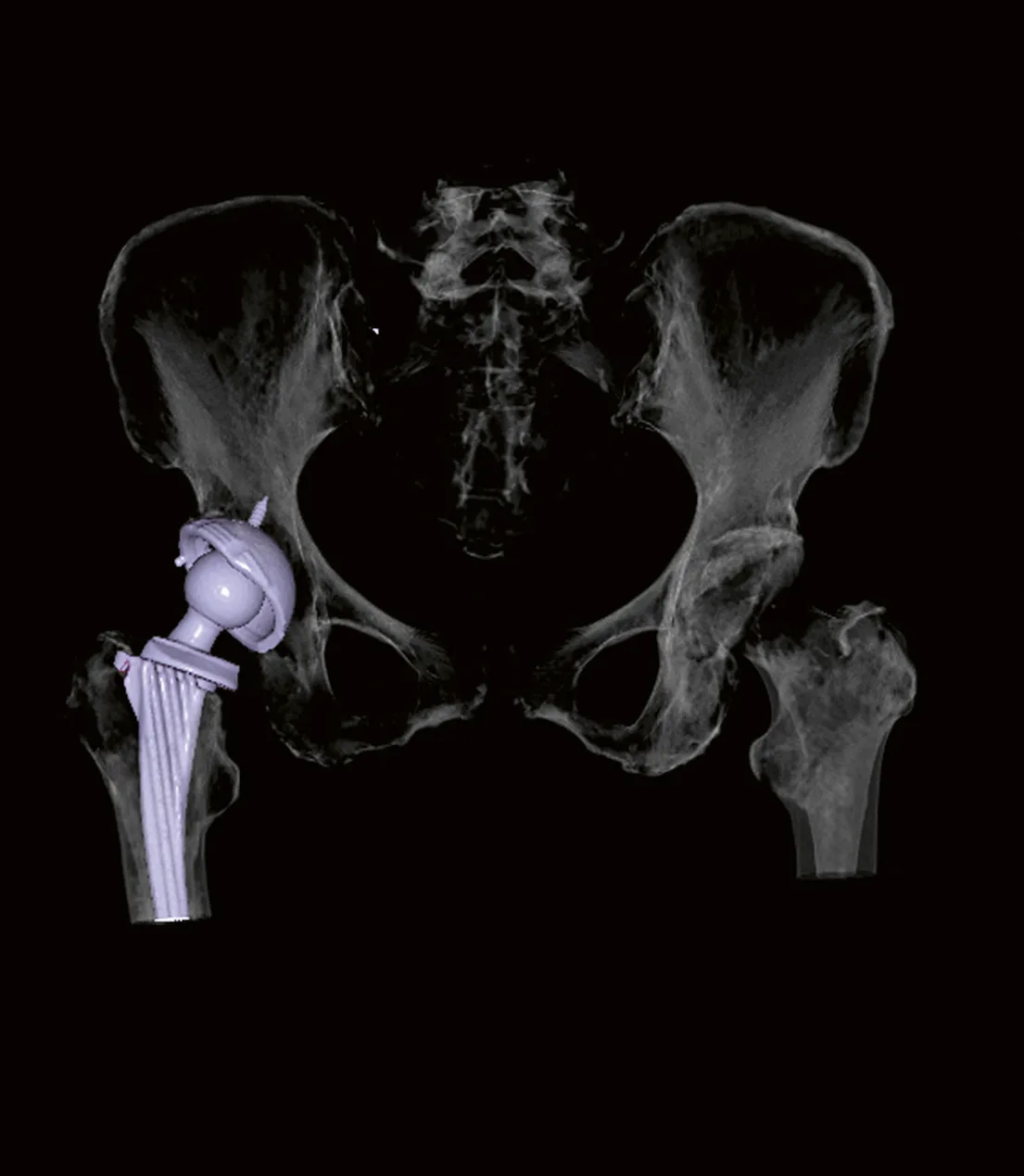 3D rendering of a hip prosthesis reconstructed with iMAR metal artifact reduction