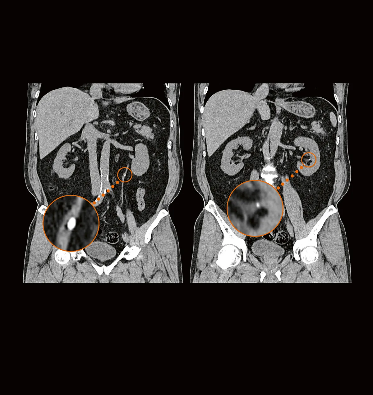 Coronal abdominal CT reconstructions with magnified views of very small kidney stones