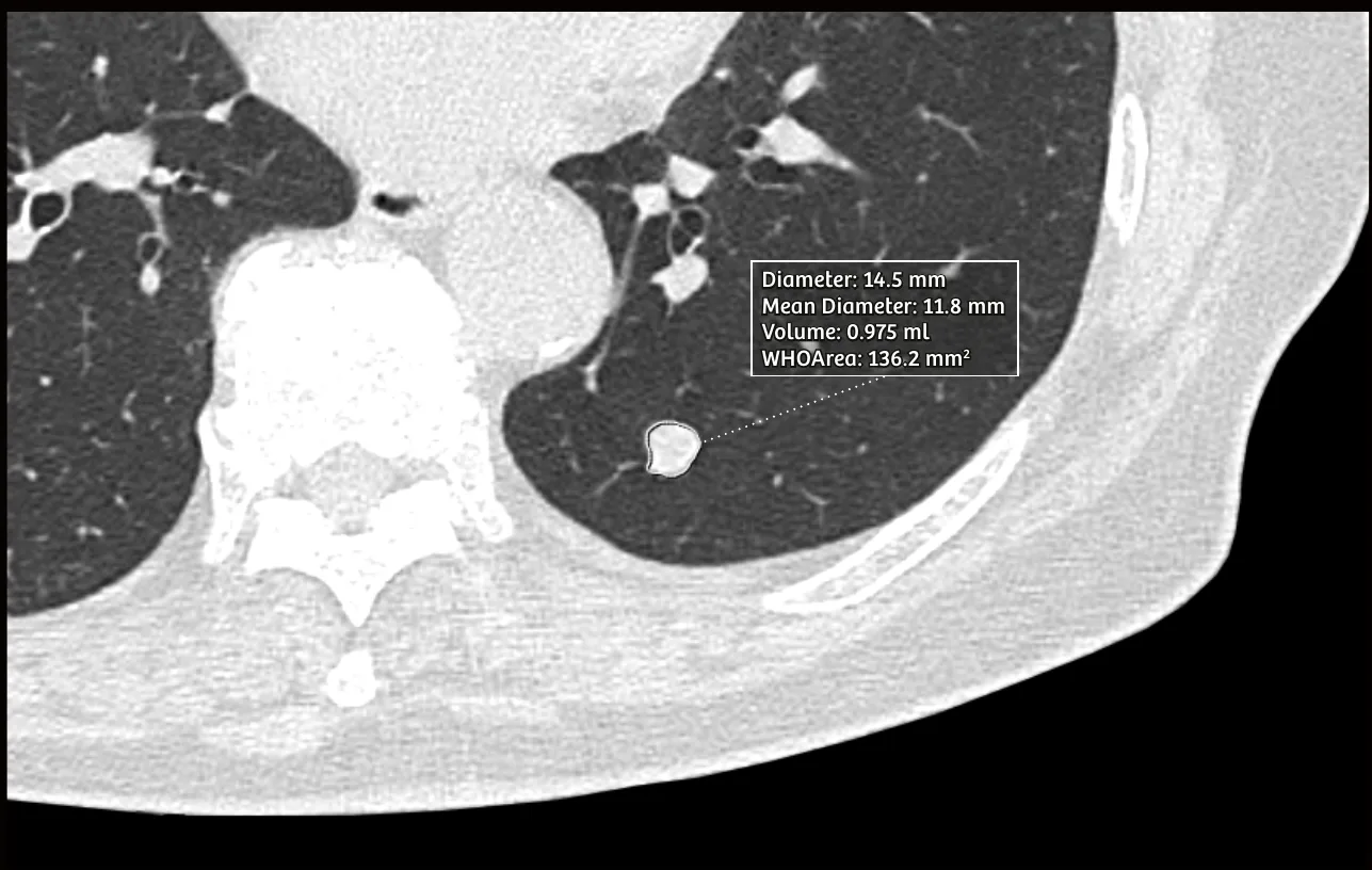 Low-dose chest CT slice with an automated lung nodule measurement overlay