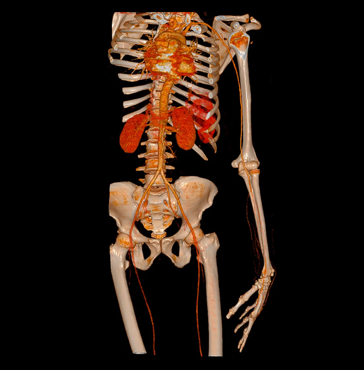 3D volume-rendered whole-body CT angiography including the upper limb vessels