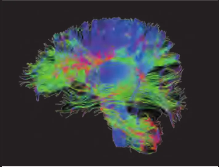 Diffusion tensor tractography of brain white-matter pathways in colour
