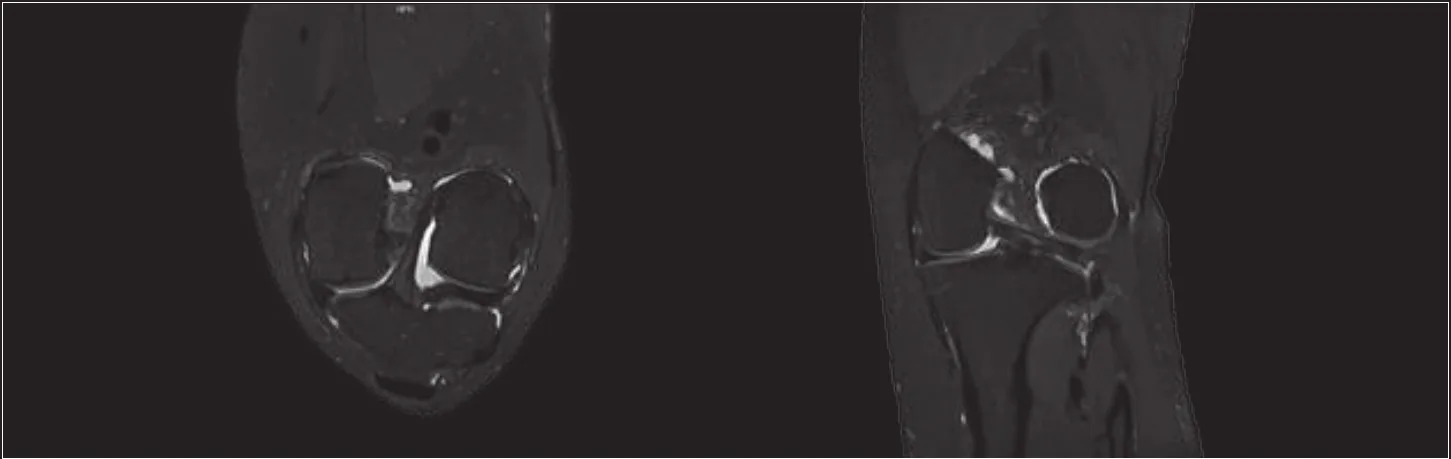 High-resolution PDW MATRIX MRI of the knee in two planes