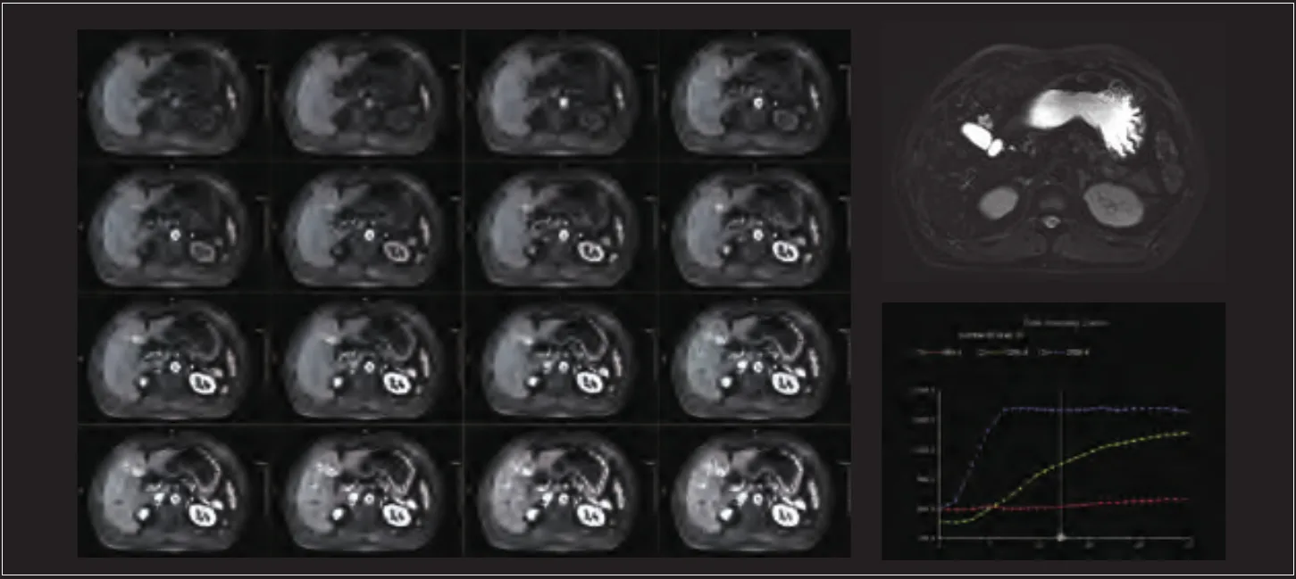 Dynamic contrast-enhanced liver MRI - 32 phases with enhancement curves