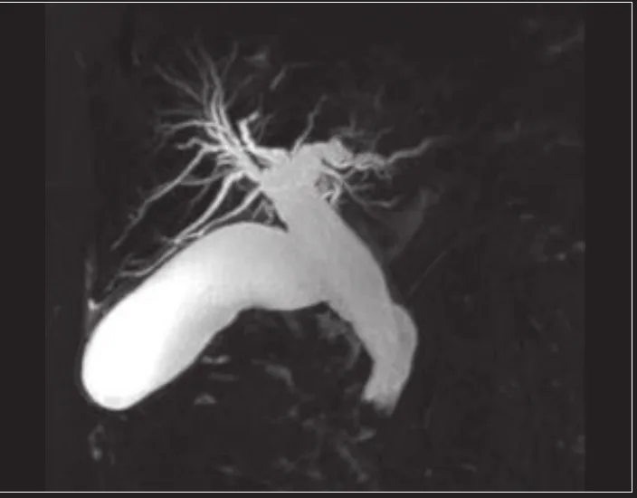 MRCP study showing the biliary tree and pancreatic duct