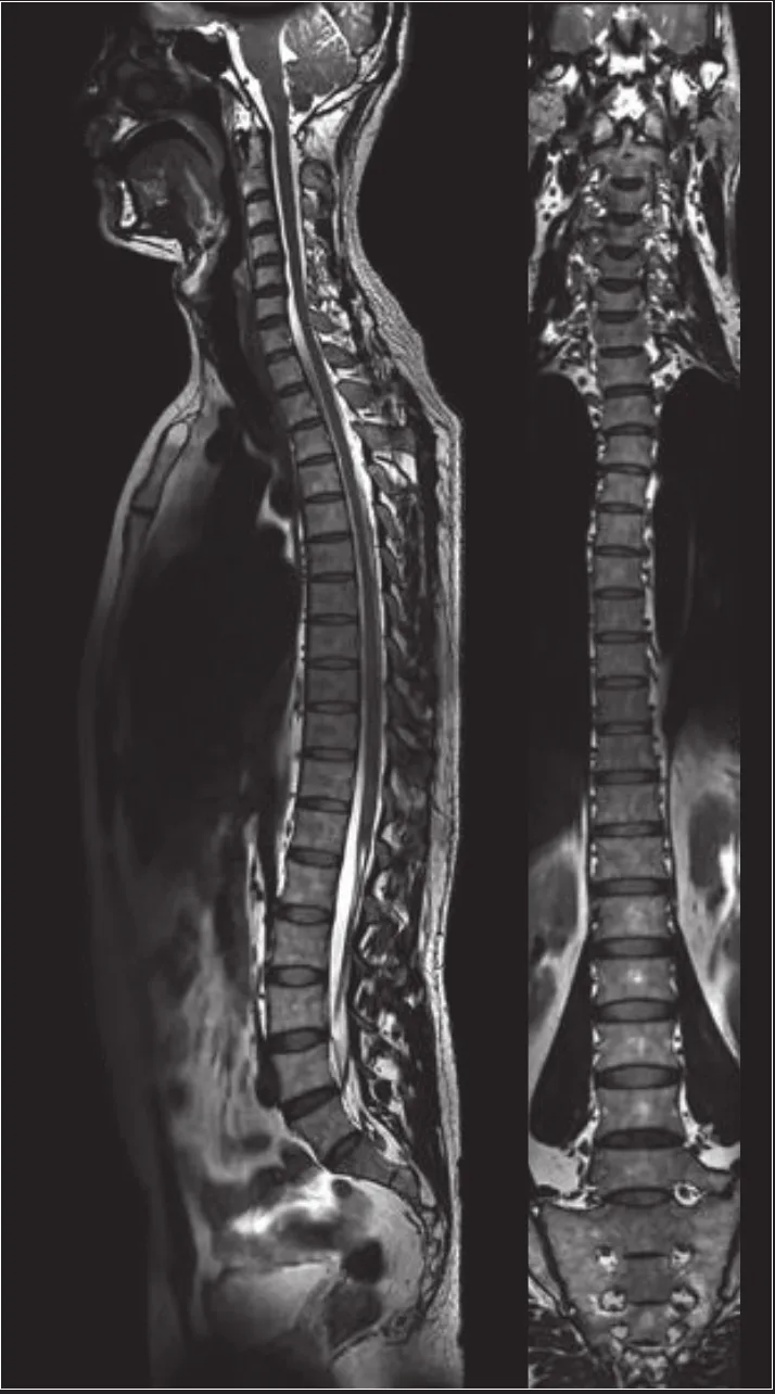 Whole-spine MRI on the uMR 780 - sagittal and coronal views of the entire spinal column